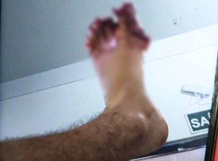Alta Floresta – Homem perde partes dos dedos do pé, em acidente contra Carro na Avenida Rondônia